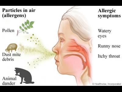 Rinita alergica (febra de fan)
